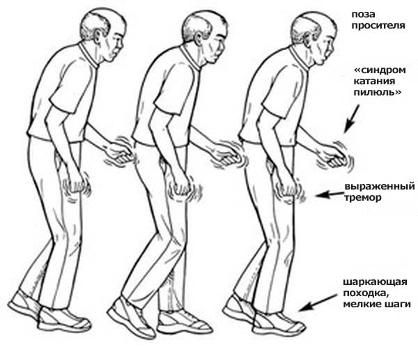 симптомы болезни паркинсона у пожилых