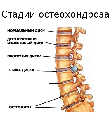 стадии остеохондроз