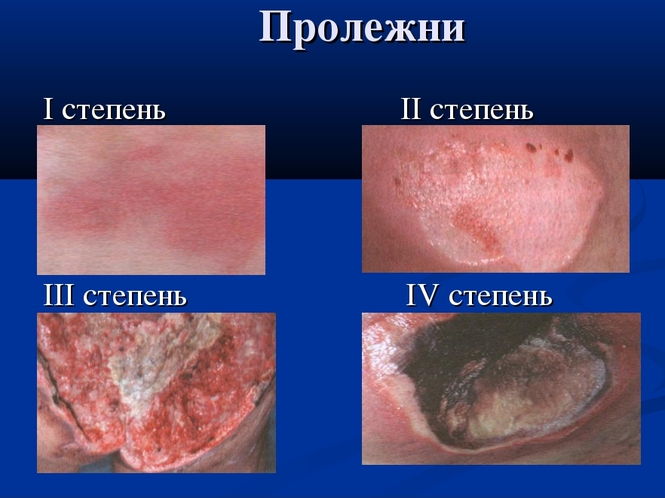 стадии пролежней