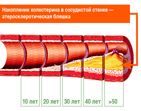 типы атеросклероза